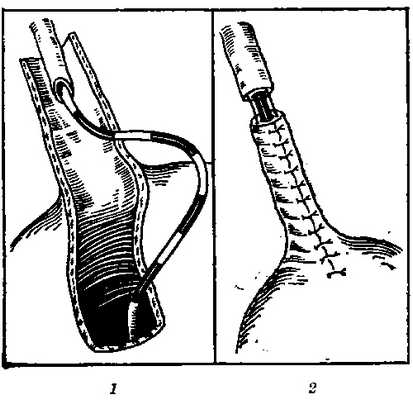 Операция восстановления мочеточника (на катетере) по Боари (некоторые способы): 1 — инвагинация мочеточника в трубку из стенки мочевого пузыря; 2 — конец мочеточника с трубкой, образованной из стенки мочевого пузыря, подготовлены к сшиванию конец в конец.