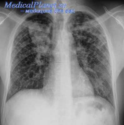 операция якобеуса