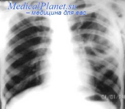 хирургия туберкулеза