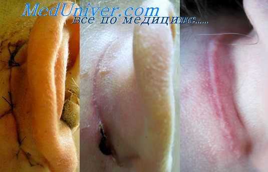 пластика заушной раны