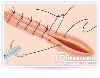 Требования к медицинским швам