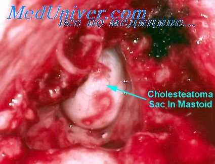 заушная рана