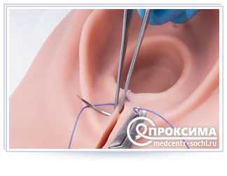 Методика наложения швов на ухо