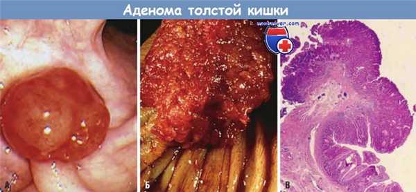 Аденома толстой кишки
