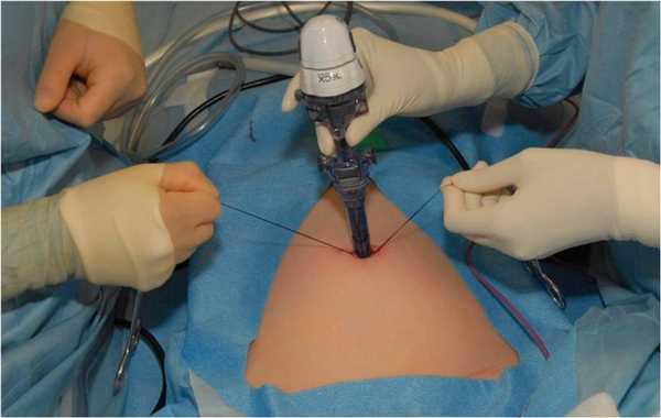 Резекция простаты через эндоскоп