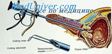 аденомэктомия