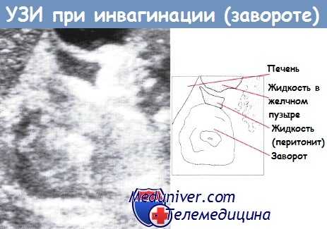 УЗИ при инвагинации толстой кишки