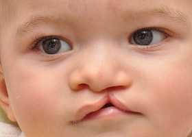 Заячья губа, фото