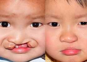 Волчья пасть, фото до и после операции