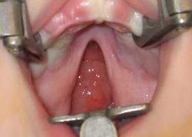 Волчья пасть у детей, фото