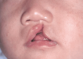 Заячья губа у человека, фото