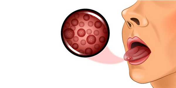 Злокачественная опухоль языка