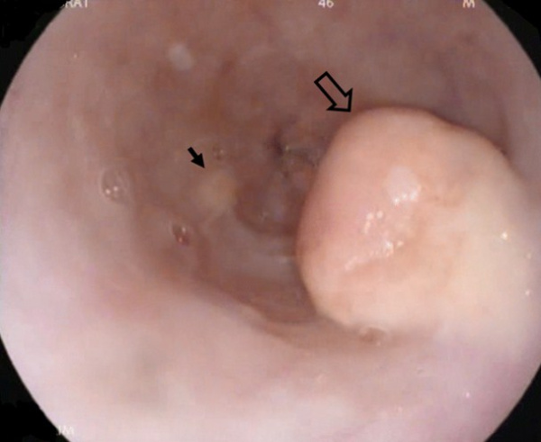 Эзофагоскопия. Опухоль Абрикосова в пищеводе