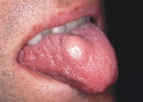 Зернисто-клеточная карцинома почки