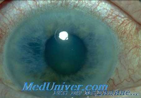 инфекции глаз