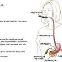 Дуоденальное зондирование