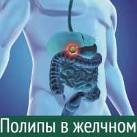 Полипы желчного пузыря