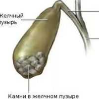 Желчнокаменная болезнь