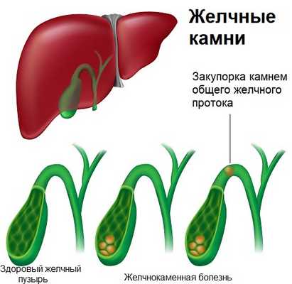 Желчнокаменная болезнь.jpg