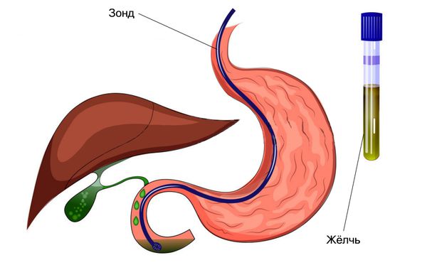Дуоденальное зондирование