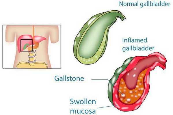 Воспаление желчного пузыря с образованием камней