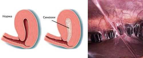 Внутриматочные синехии
