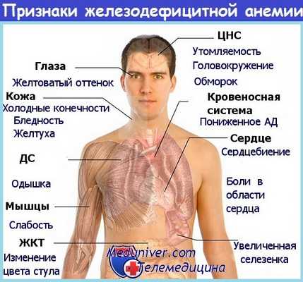 Признаки железодефицитной анемии