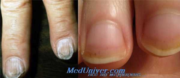 Ногти при железодефицитной анемии