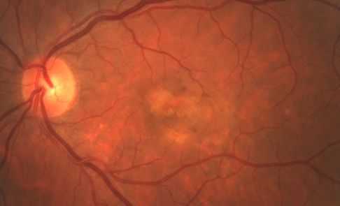 Отслойка пигментного эпителия сетчатки
