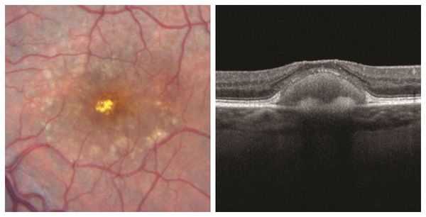 Патологическое скопление в области макулы при вителлиформной макулодистрофии взрослых