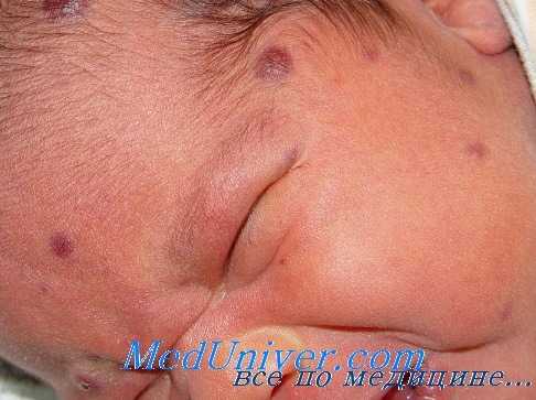 Цитомегаловирусная инфекция у новорожденного - ЦМВ-инфекция