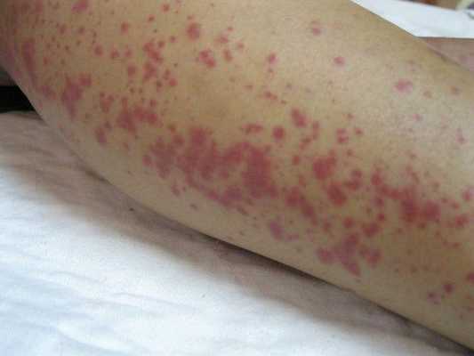 Сыпь, характерная для лептоспироза