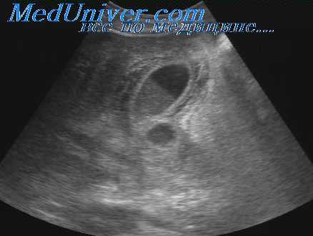 холецистит