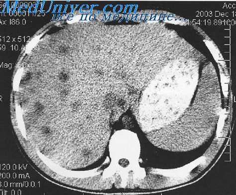 механическая желтуха