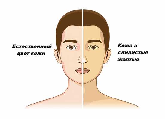 Желтуха болезнь.jpg