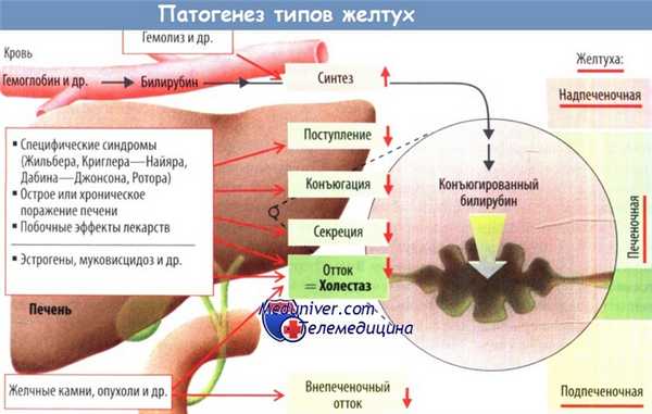 Желтуха. Причины и варианты желтухи