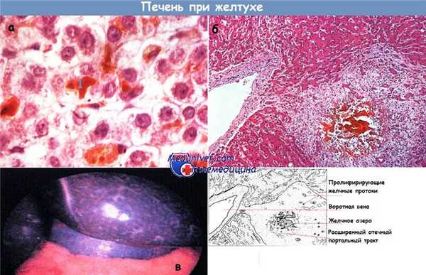 Печень при желтухе