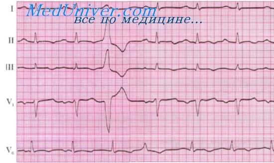 экстрасистолия