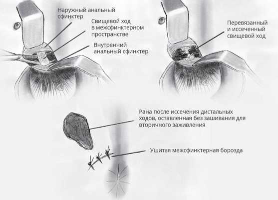 Операция при свищах методом LIFT
