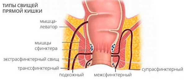 Типы свищей прямой кишки
