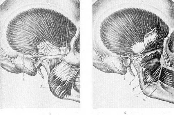 Рис. 1. Жевательные мышцы: а — височная и собственно жевательная мышцы; б — крыловидные мышцы; 1 — височная мышца; 2 — собственно жевательная мышца: 3 — латеральная крыловидная мышца; 4 — медиальная крыловидная мышца; 5 — крылонижнечелюстной шов; 6 — щечная мышца.