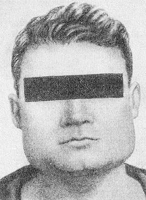 Рис. 2. Истинная двусторонняя гипертрофия собственно жевательных мышц.