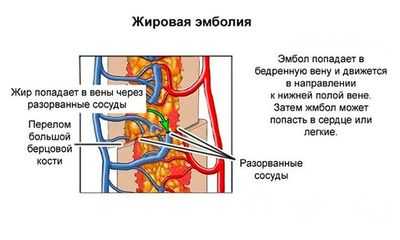 Жировая эмболия