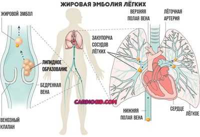 Жировая эмболия легких