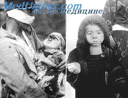 острая лучевая болезнь