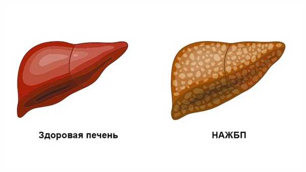 Неалкогольная жировая болезнь печени