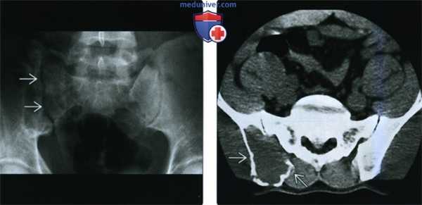 Рентгенограмма, КТ, МРТ при злокачественной фиброзной гистиоцитоме кости