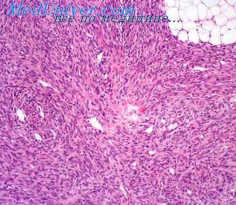 фиброзная гистиоцитома