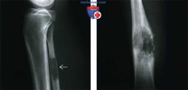 Рентгенограмма, КТ, МРТ при злокачественной фиброзной гистиоцитоме кости
