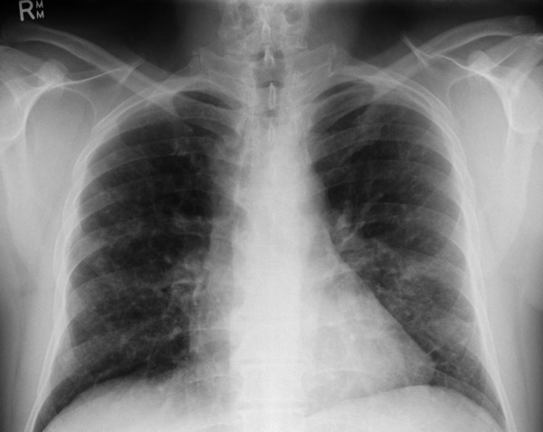 Гистиоцитоз X